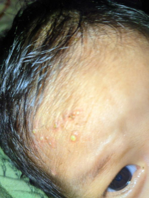 Kepala Anak Bentol2 bernanah