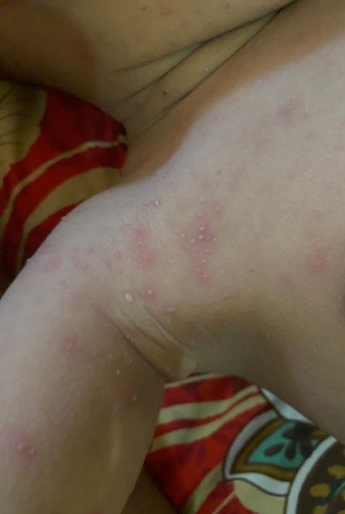 Bintik merah berisi cairan putih seperti nanah