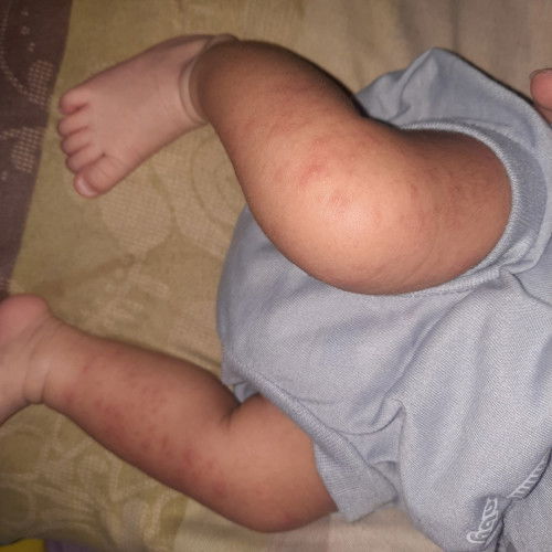 Bruntusan merah pada bayi usia 2 minggu