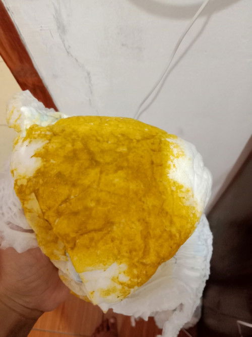 Bayi 2 bulan pasca dirawat