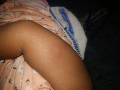 Prickly heat/bunganga araw