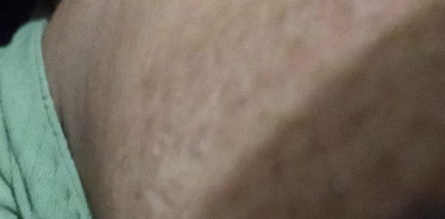 Sekitar payudara menghitam