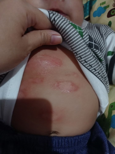 Ruam merah dan gatal di dada bayi, ini karena apa? Mau bawa ke dokter anak di tempatku jauh 🥲