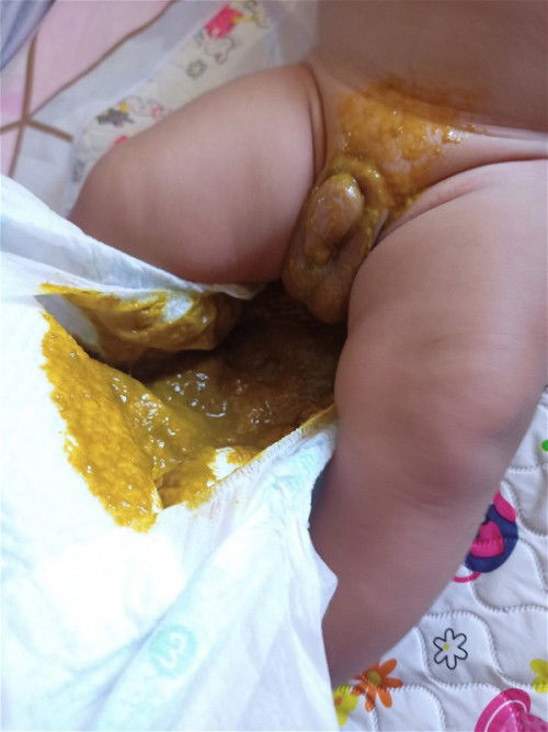 Normal na poops? Watery na po ba ito?