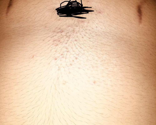 มีแม่ๆบ้านไหนเป็นแบบนี้ไหมคะมีผื่นขึ้นบริเวณหน้าท้องใครพอมีวิธีแก้ไหมค่ะ