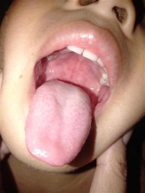 Bintik2 putih di rongga mulut dan tenggorokan anak+demam