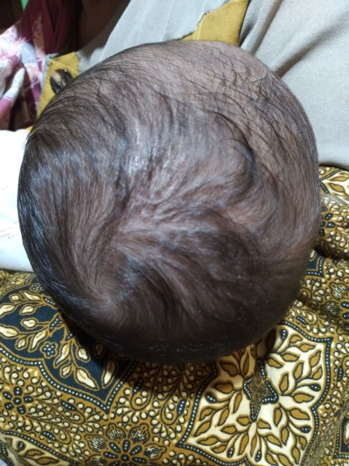 Kulit kepala bayi seperti berketombe