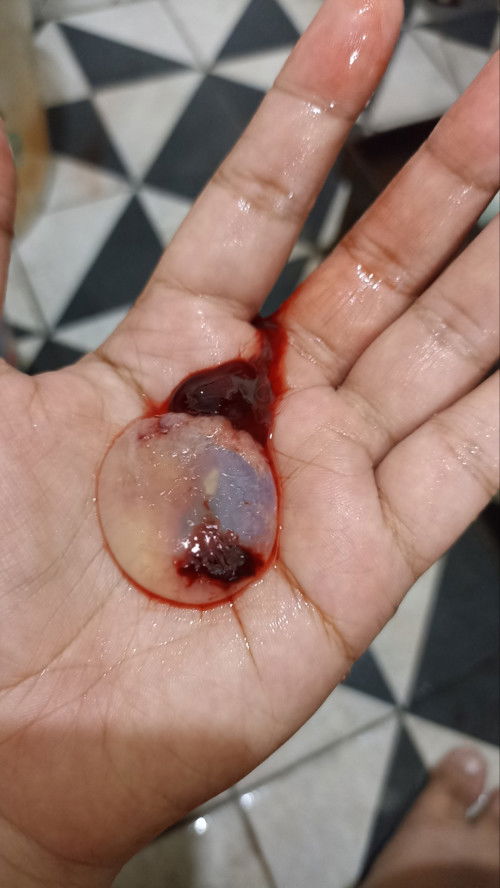 keguguran
hari ini saya keguguran, janinnya tidak berkembang.. sampai rumah, keluar seperti ini.....