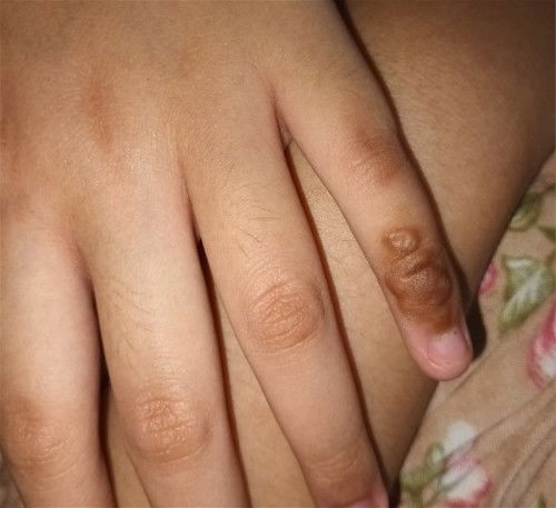 Bunda2 maaf mau tanya, kira2 kaya cairan yg ada di jari kelingking adek ku itu apa ya? Bahaya/tidak?