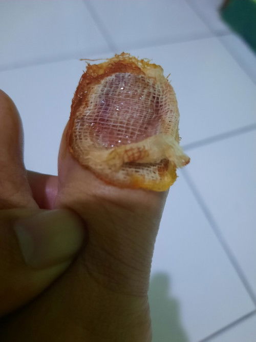 Apakah kasanya bisa lepas sendiri??