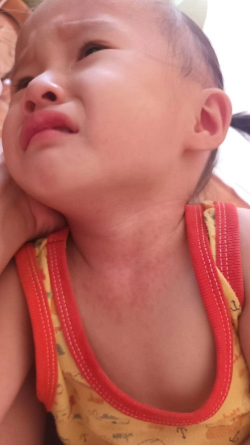 ผื่นร้อนผื่นคัน