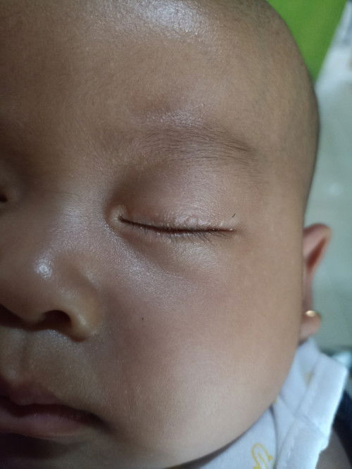 Ada bintik putih di kelopak mata