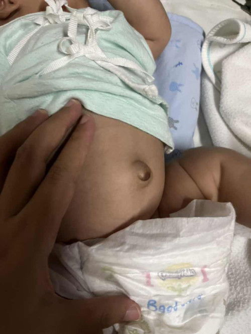 ลูกอายุ 1 เดือน 1 สัปดาห์ สะดือจุ่นมากผิดปกติไหม