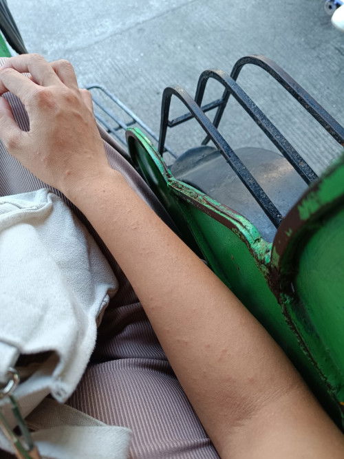 Skin Rashes o Heat Rash?