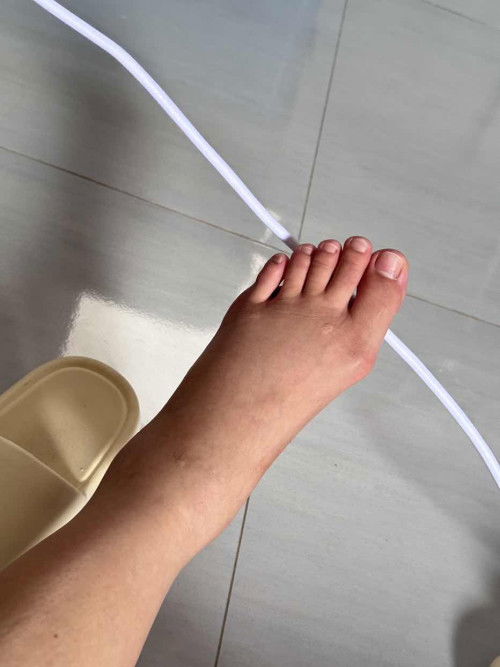 เท้าบวมมากหลังคลอด(ธรรมชาติ)