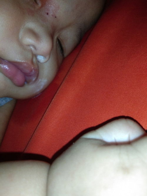 Bayi 6bulan keluar asi dari hidung