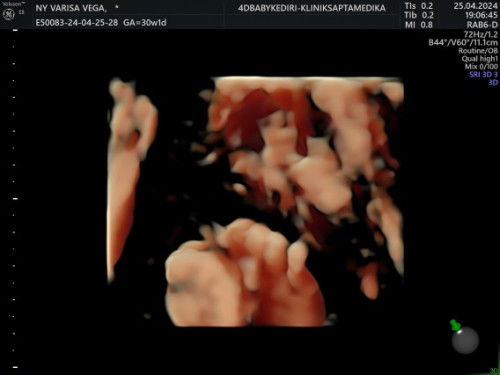 Hasil USG 4D