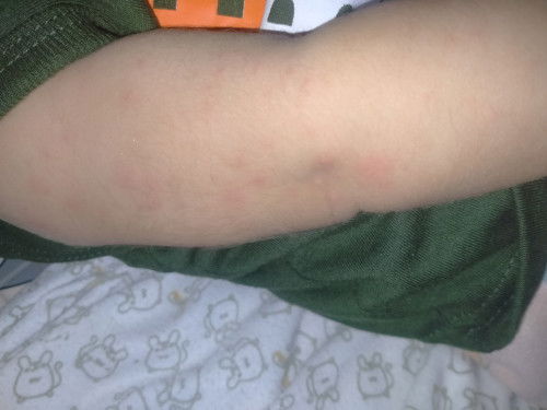 Bayi 5 bulan tiba2 keluar bintik2 seluruh badan