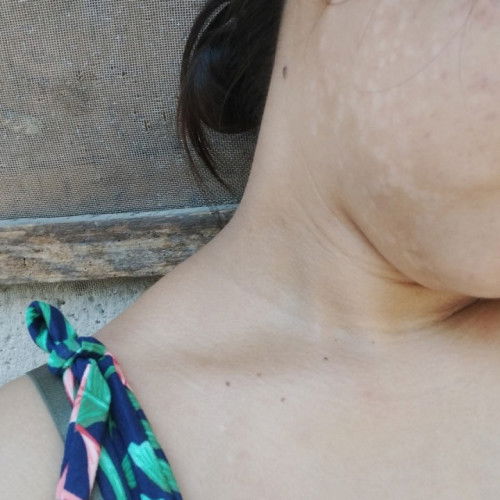 Normal lang po ba ang ap ap or an an sa mukha pag buntis?