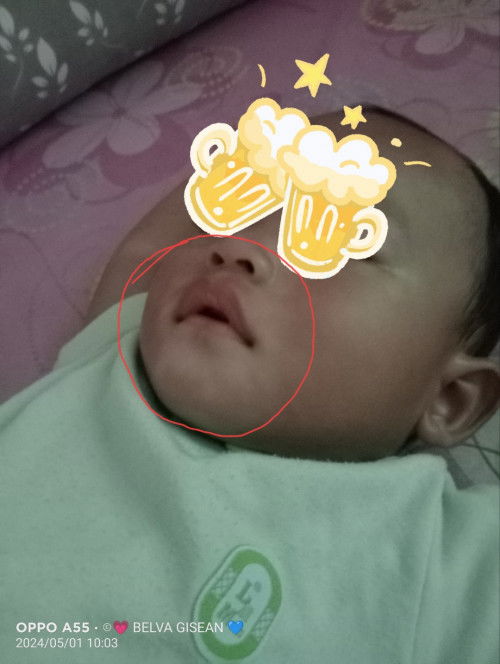 Bekas putih sekitar mulut bayi