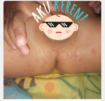Ruam pada anak