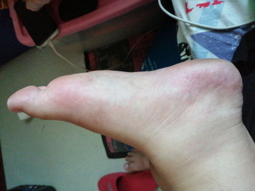 Pamamanas

Hello po tanong lng po, kapag masakit po ba ang talampakan namamanas na po ba ito?