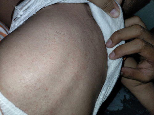 Dermatitis atopik yang sering kambuh, adakah anak bunda yang  mengalami hal yang sama?