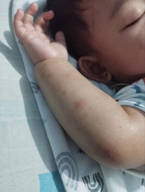 Gatal pada anak usia 8 bln