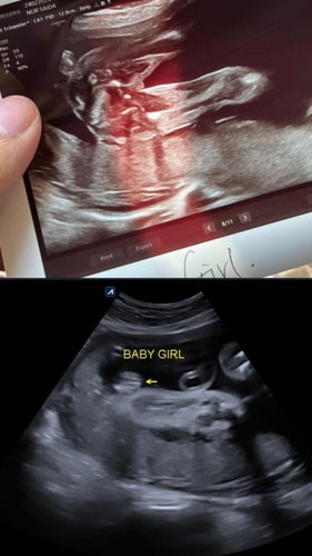 Baby Gender 31 weeks
