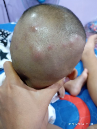 สิวหรือผดไม่รู้ขึ้นที่หัวลูกเรา