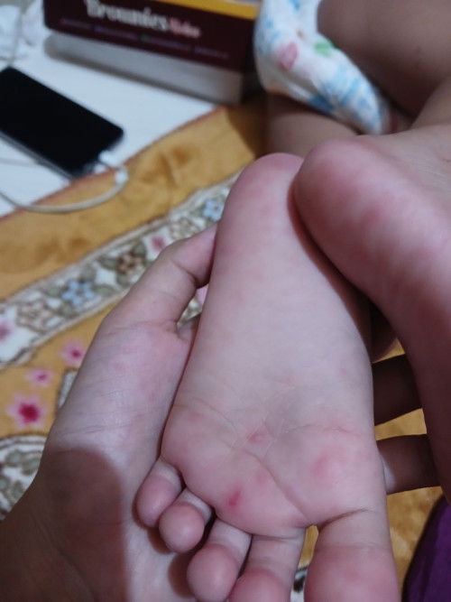 Tiba-tiba bentol banyak di telapak tangan, kaki dan perut 🥲