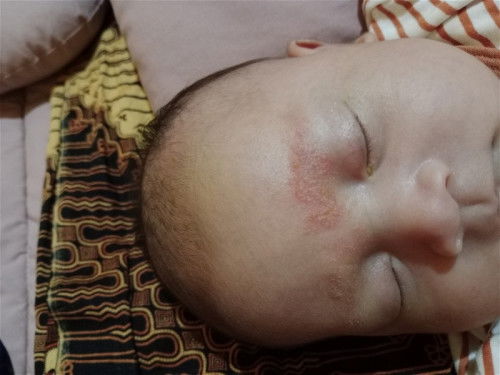 Beruntusan pada bayi usia 1 bulan