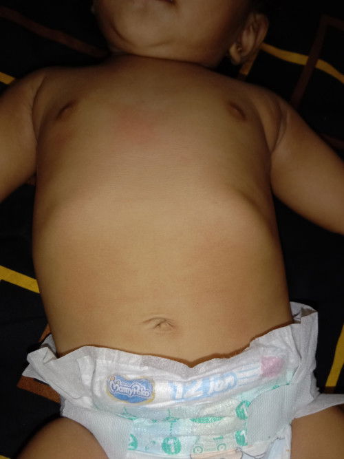 Tulang rusuk bayi menonjol