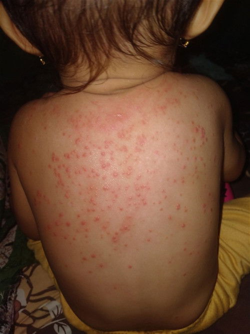 Kulit bruntusan. Apakah biang keringat?