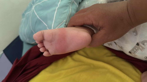 Anak digigit serangga