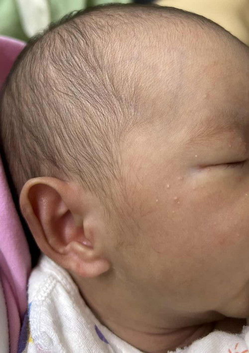 น้องเป็นผดแบบนี้ใช้ครีมอะไรดีคะ