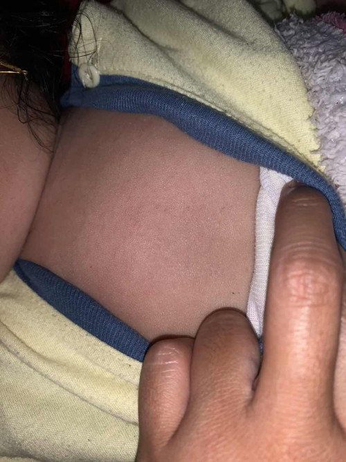 Bintik-bintik di tangan kaki dan dada bayi