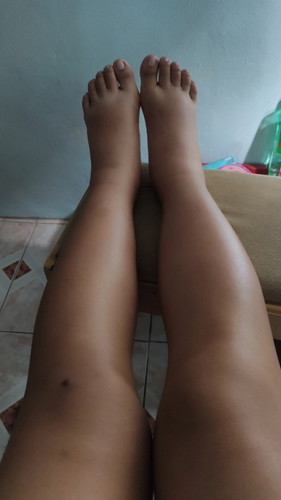 Postpartum edema