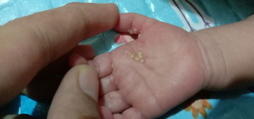 Telapak tangan bayi melenting