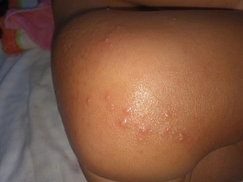 Gatal gatal dikasih obat apa