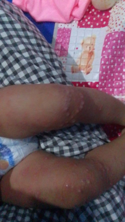 Muncul bintik2 merah berair