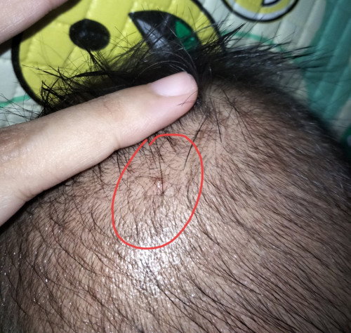Kepala bayi bentol ada isinya