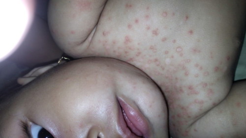 Anak gatal adem udah 2minggu . Obat habis kambuh lagi malah tambah merah2 , solusinya pake salep apa