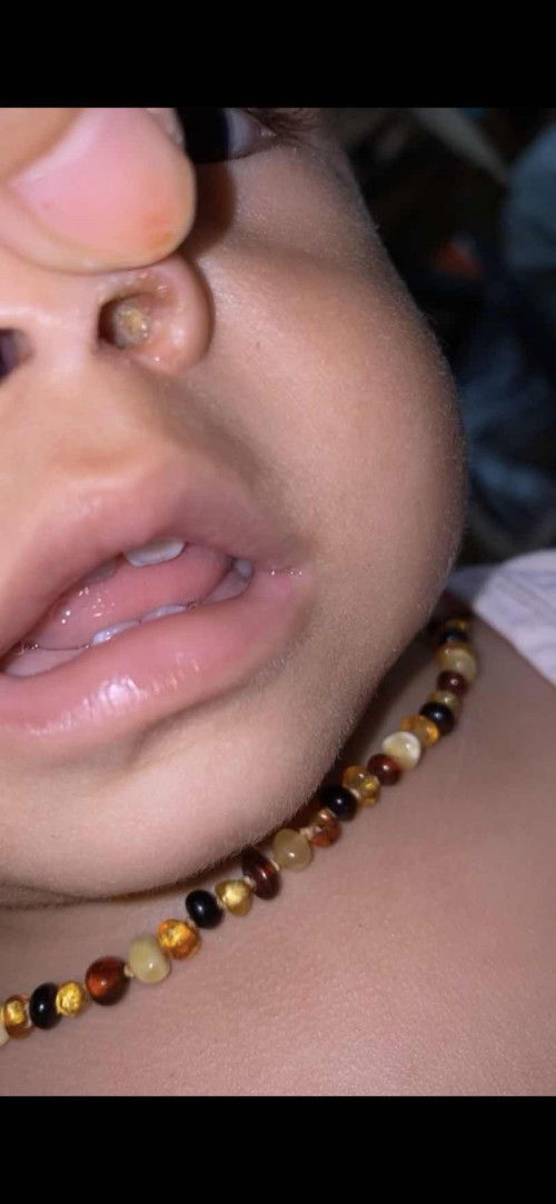 hidung berair tapi bukan ingus