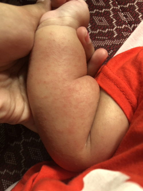 Badan bayi merah bintik