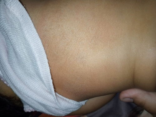 Kulit anak kering bersisik