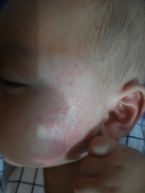 Kukit merah dan kering