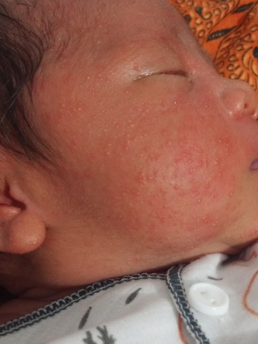 Ruam wajah bayi