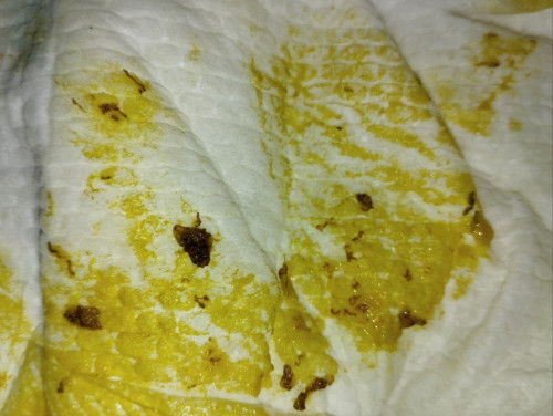 Trẻ 7m sáng nay đi phân có rất nhiều sợi chỉ đỏ