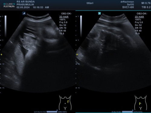 Hpl Juni, sering mimpi lahiran